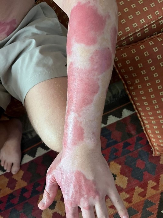 The image displays a severely burned and blemished arm of a patient. Our wound burn rehabilitation treatment takes care of it.